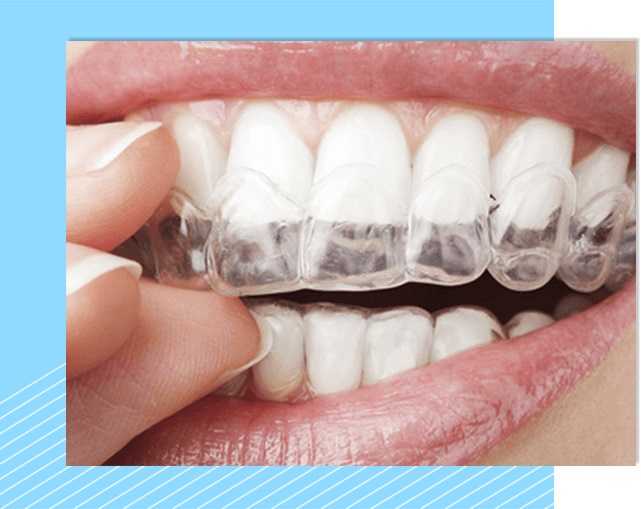 Элайнеры в Харькове - стоматология Dental Line