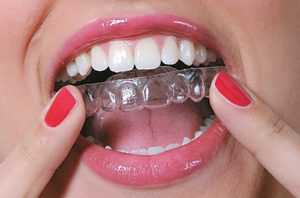 Элайнеры в Харькове - dentalline.com.ua