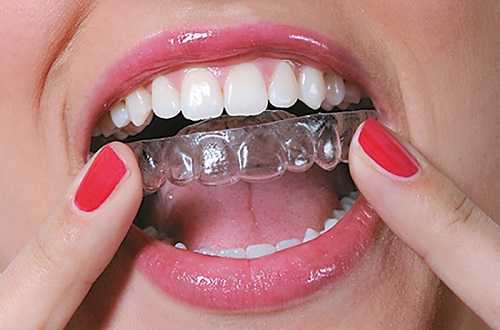 Элайнеры в Харькове - dentalline.com.ua