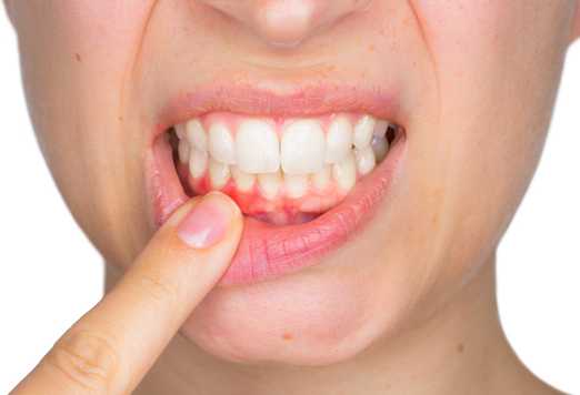 пародонтит_лечение в Харькове - Dental Lline - фото - 3