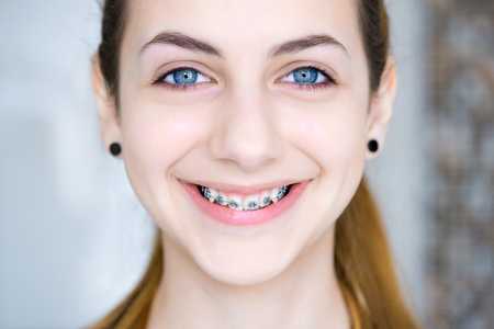 Брекеты - цена - Харьков - стоматология - Dental Line