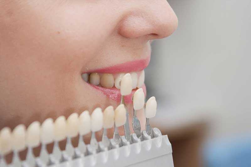 Реставрация передних зуб - стоматология Dental Line в Харькове - фото