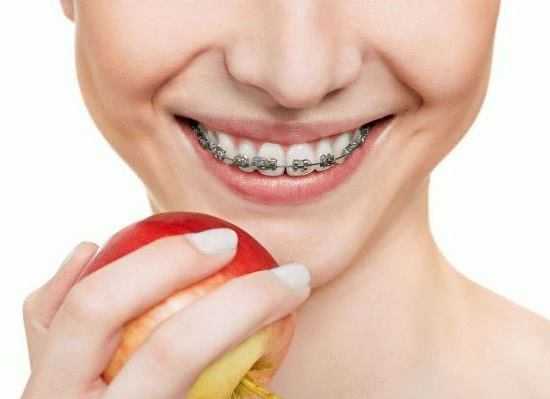 Установка брекет-систем для взрослых в Харькове - dentaline.com.ua - фото
