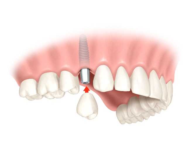 Установка имплантов зубов в Харькове - стоматология Dental Line - фото - 1