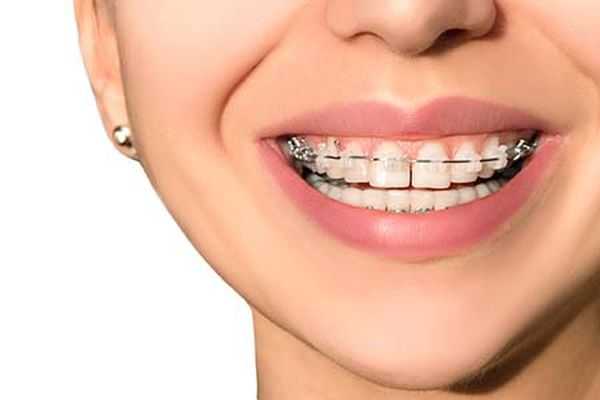 Как правильно ухаживать за брекетами - стоматология Dental Line в Харькове - фото