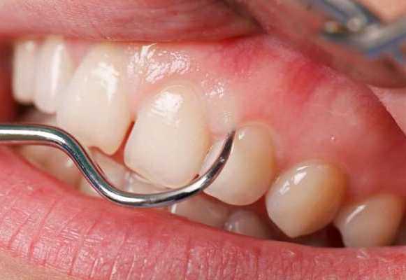 Лечение гингивита - стоматология Dental Line в Харькове - фото