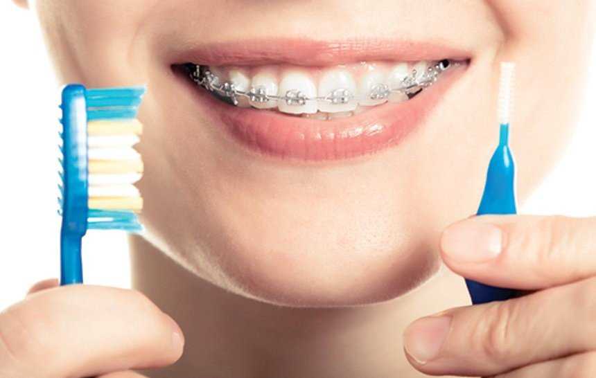 Рекомендации после установки брекет-системы - dentalline.com.ua - фото