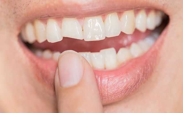 Лечение сколов зубов - стоматология Dental Line в Харькове - фото