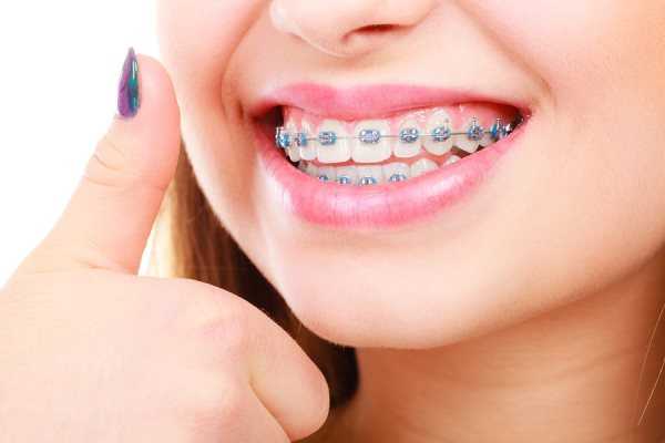 Мифы и правда о брекетах - стоматология Dental Line в Харькове - фото