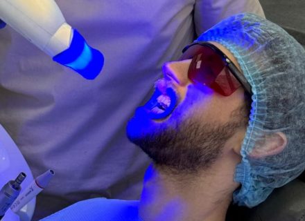 Безопасное отбеливание зубов - dentalline.com.ua