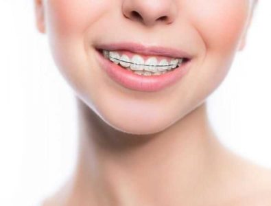 Установка брекетов для взрослых в Харькове - стоматология Dental Line - фото