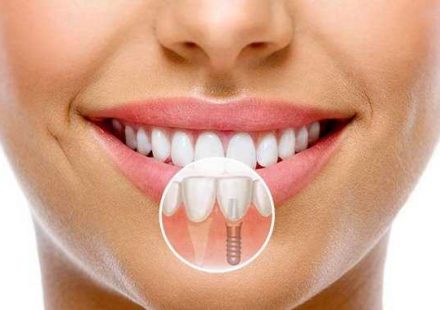 Что делать если нет зуба -dentalline.com.ua - фото