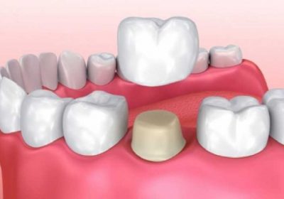 Что лучше - коронка или пломба - стоматология Dental Line в Харькове - фото