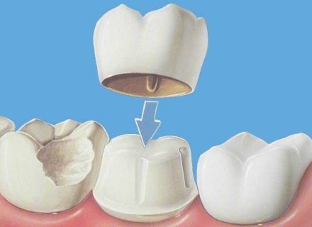 Что лучше - коронка или пломба - dentalline.com.ua - фото