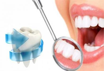 Фторирование зубов в Харькове - dentalline.com.ua - фото