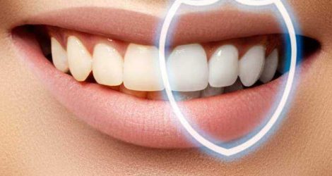 Фторирование зубов в Харькове - стоматология Dental Line в Харькове - фото