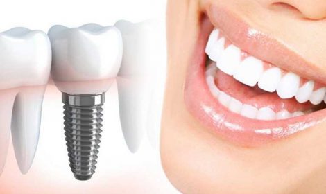 Имплантация зубов в Харькове - dentalline.com.ua - фото