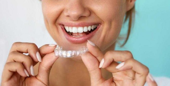 Элайнеры для выравнивания зубов - что это такое - стоматология Dental Line в Харькове -фото