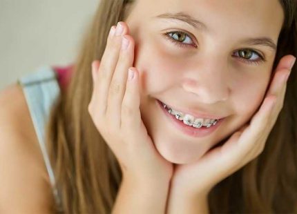 Капы и брекеты в Харькове dentalline.com.ua