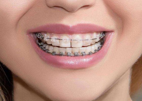 Установка керамических брекет-систем в Харькове - стоматология Dental Line