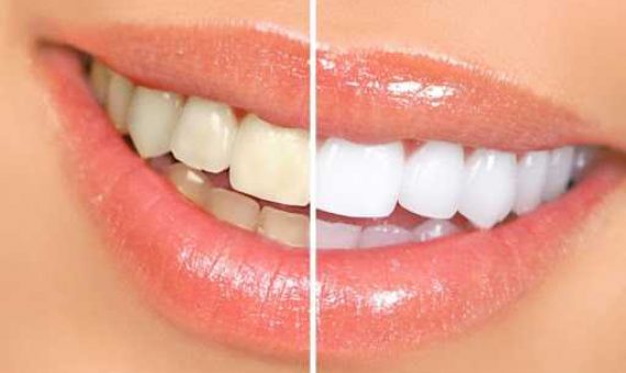 Отбеливание зубов - мифы и факты - стоматология Dental Line- фото