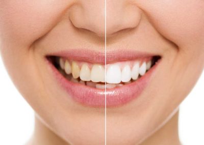Как ухаживать за зубами после отбеливания - dentalline.com.ua - фото