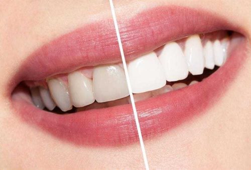 Качественное отбеливание зубов - Dental Line Харьков - фото