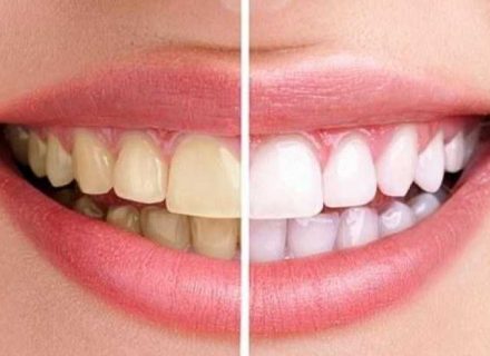 Почему желтеют зубы - причины и решение - dentalline.com.ua - фото