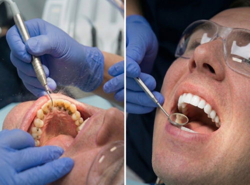 Профессиональная чистка зубов – стоматология Dental Line в Харькове – фото