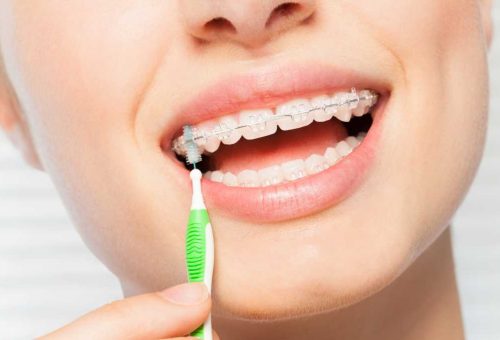 Рекомендации после установки брекетов - стоматология Dental Line в Харькове - фото