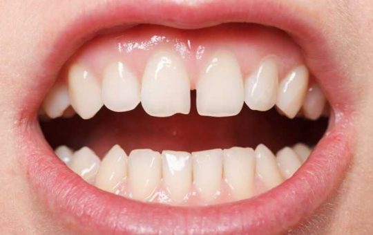 Что делать, если откололся зуб - Стоматология Dental Line Харьков - фото