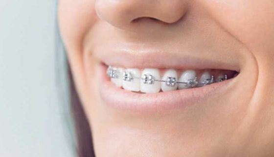Установка металлических брекетов в Харькове - стоматология Dental Line