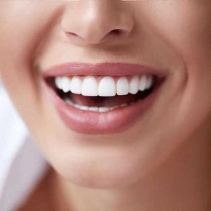 Портятся ли зубы под винирами - стоматология Dental Line в Харькове - фото