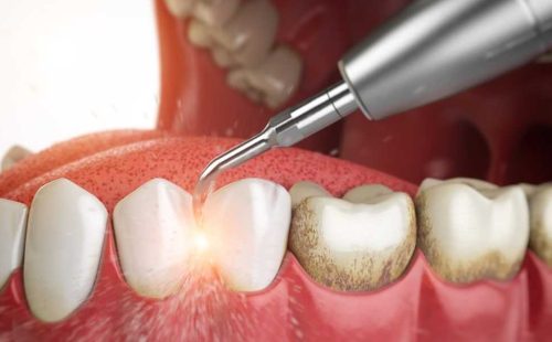 Зубной камень - причины появления и лечение - стоматология Dental Line в Харькове - фото